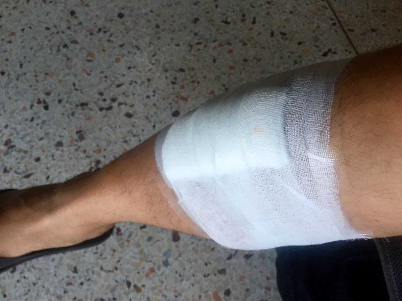 Bandaged leg.